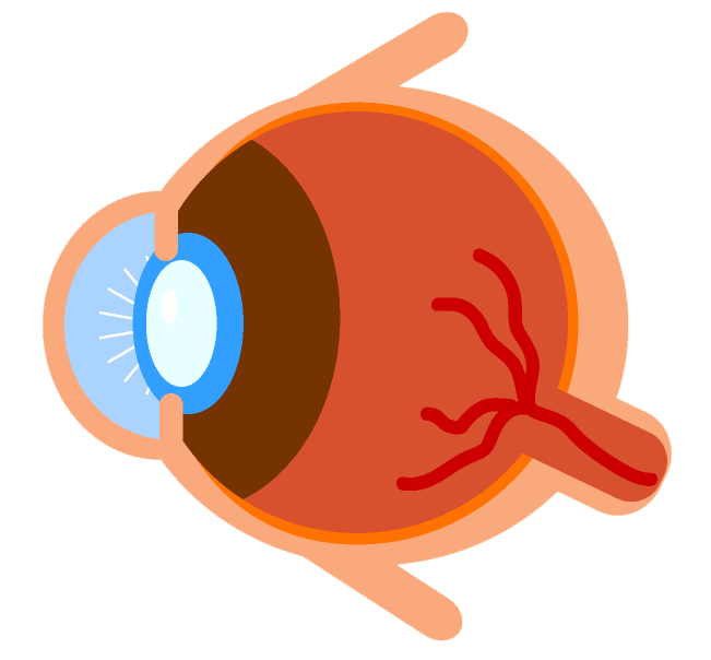 Cataract surgery